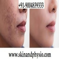 BEST TREATMENT FOR ACNE PIMPLES